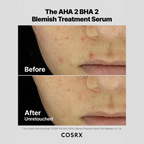 The AHA 2 BHA 2 Blemish Treatment Serum