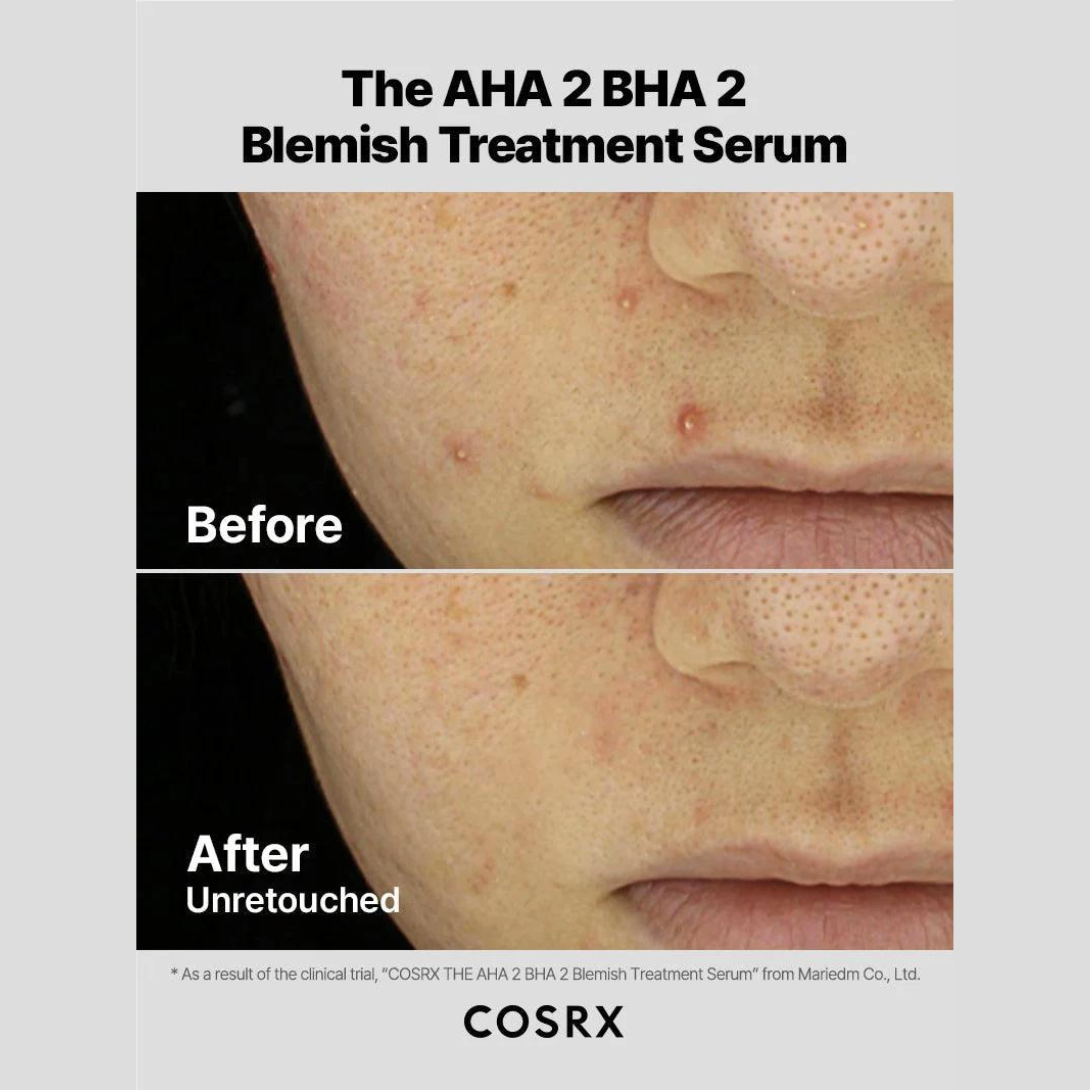 The AHA 2 BHA 2 Blemish Treatment Serum