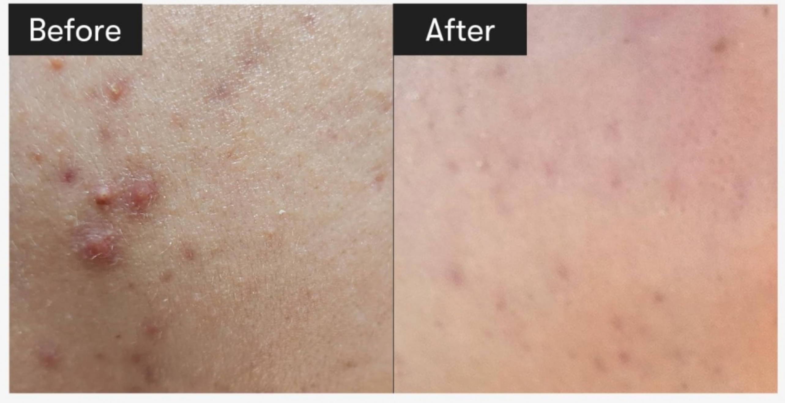 VT CICA Reedle Shot 300