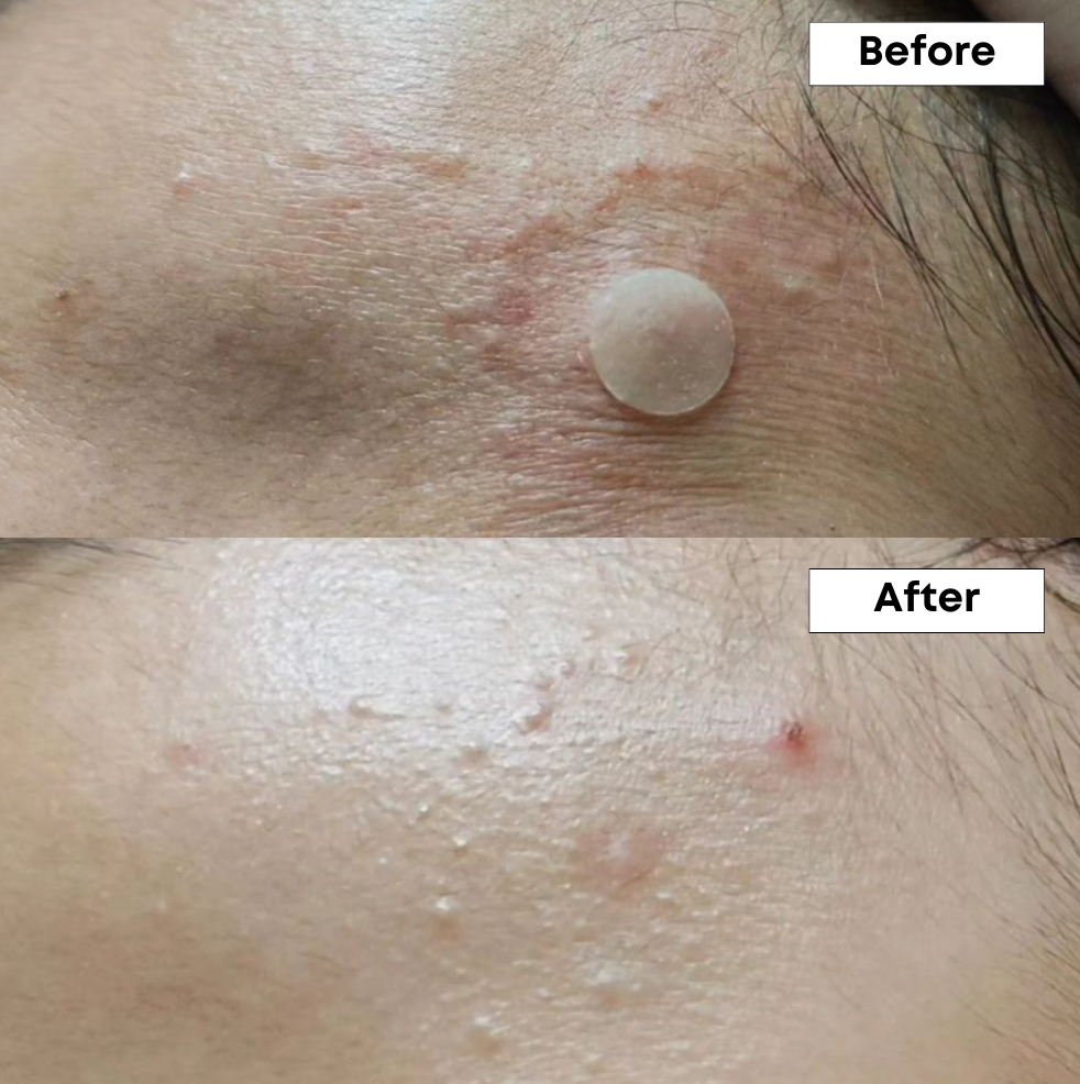 A-Control 10% Azelaic Acid Serum