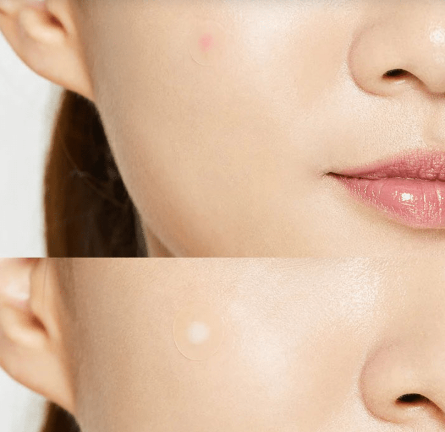 Acne Pimple Master Patch (24 patches) - SUUJA